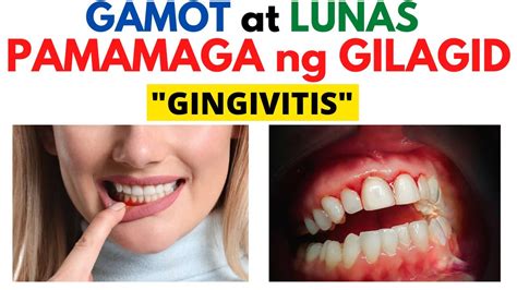 Mga Dapat Mong Malaman Kung Ikaw ay Magpapabunot ng Ngipin.